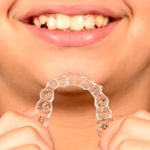 Invisalign Photo