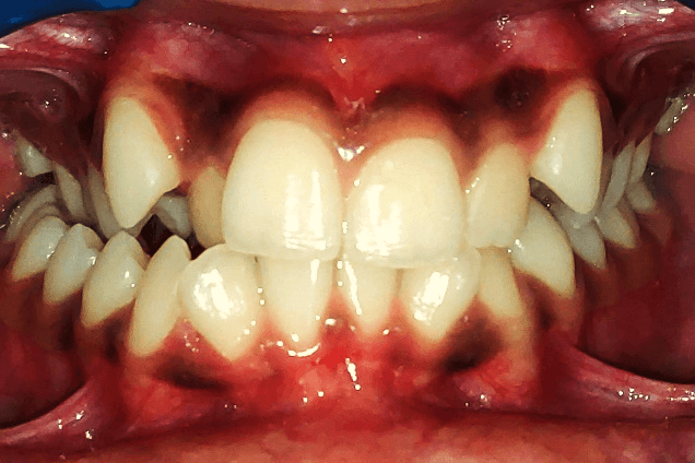 Case 4: Crossbite/ClassIII