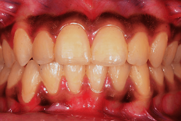 Case 4: Crossbite/ClassIII