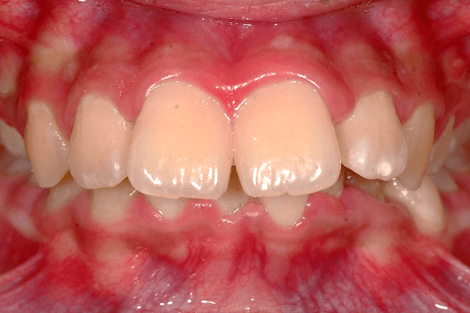 Case 5: Class II Div 1/Deep Bite