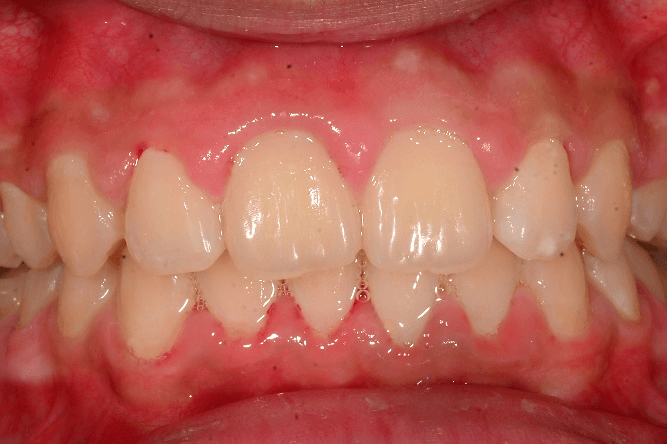 Case 5: Class II Div 1/Deep Bite