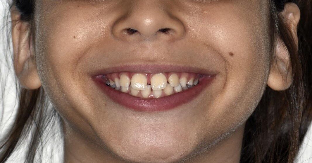 Case 8: Mixed Dentition