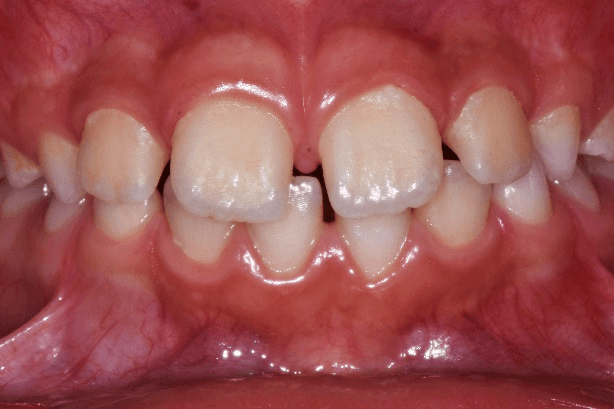 Case 8: Mixed Dentition