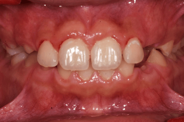 Case 8: Mixed Dentition