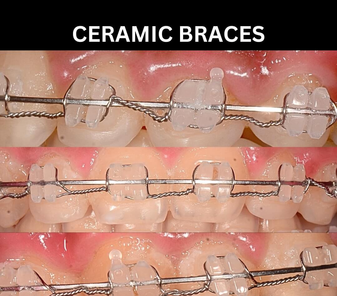 Ceramic Braces