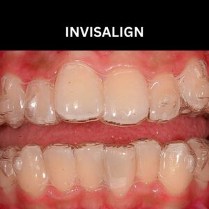 Invisalign