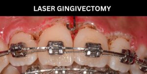 Laser Gingivectomy