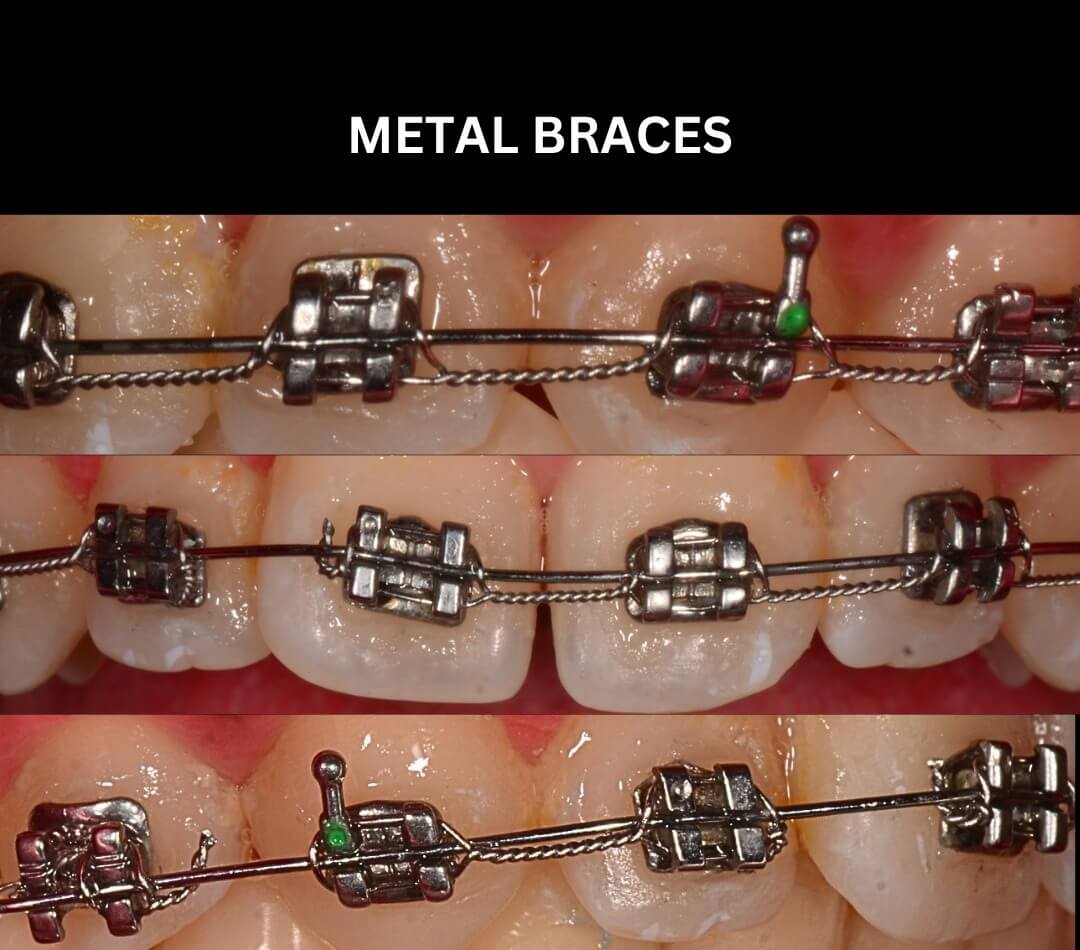 Metal Braces