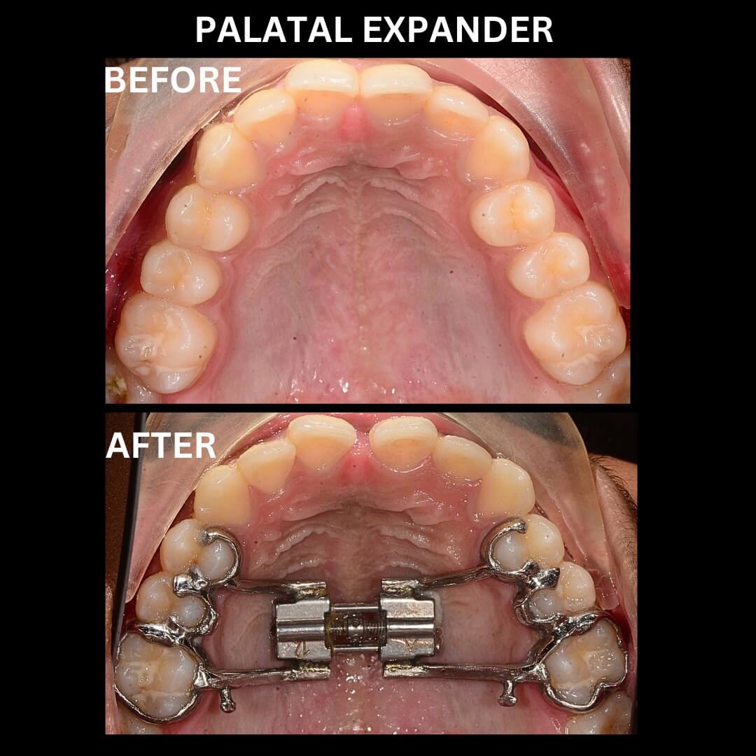 Palatal Expander