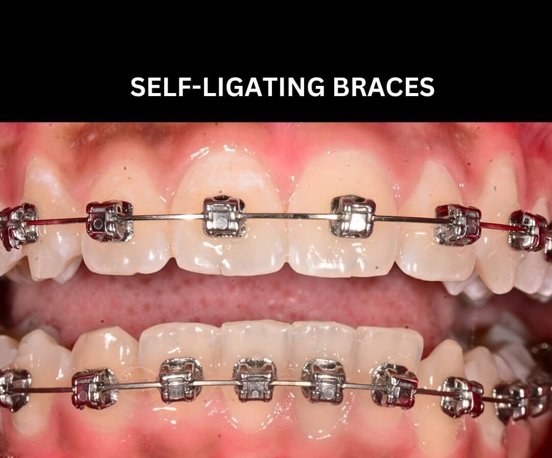 Self Ligating Braces